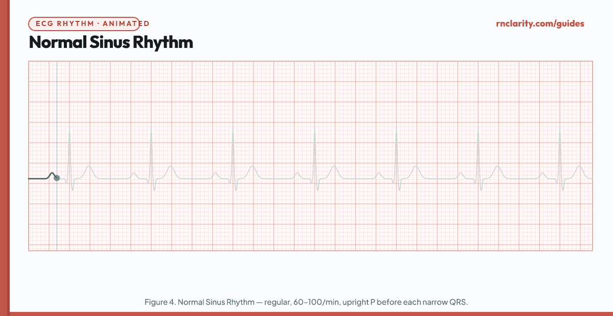 Animated ECG strip showing Normal Sinus Rhythm: regular rhythm at 60–100/min, upright P waves in lead II, narrow QRS complexes, PR interval 0.12–0.20 seconds, consistent R-R intervals.