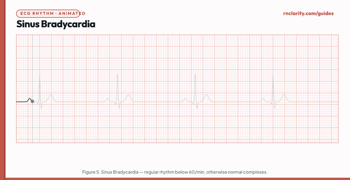 Animated ECG strip showing Sinus Bradycardia: regular rhythm at rate below 60 per minute, upright P waves in lead II, narrow QRS, PR interval normal, R-R intervals longer than normal.