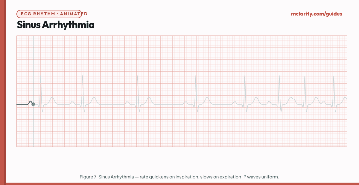 Animated ECG strip showing Sinus Arrhythmia: rate varies with respirations, increasing during inspiration and decreasing during expiration, upright P waves, narrow QRS, R-R intervals vary rhythmically.