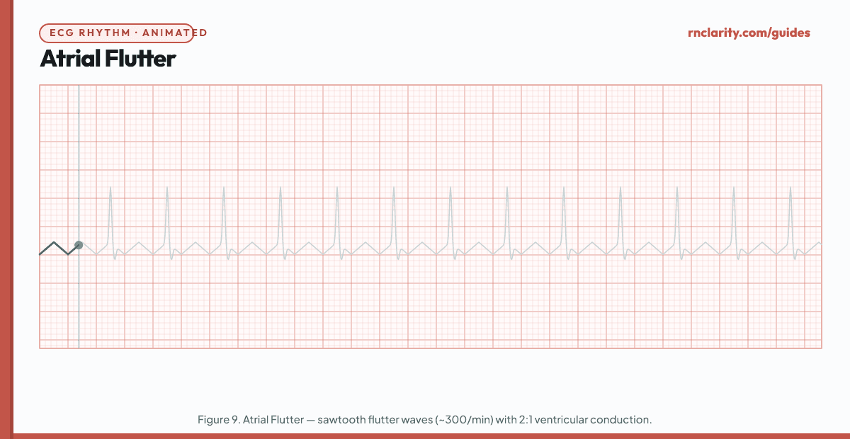 Animated ECG strip showing Atrial Flutter: sawtooth flutter waves (F waves) at 250–350 per minute, regular flutter wave pattern most visible in leads II, III, aVF, and V1, ventricular rate varies with AV conduction ratio (commonly 2:1 or 4:1), narrow QRS complexes.