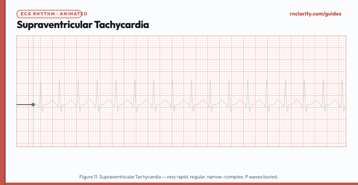 Animated ECG strip showing Supraventricular Tachycardia (SVT): very rapid regular narrow-complex tachycardia at 150–250 per minute, P waves absent or buried in T waves, abrupt onset, narrow QRS complexes.