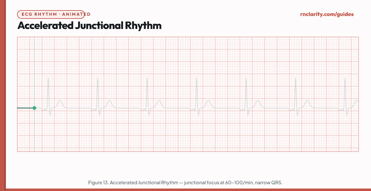 Animated ECG strip showing Accelerated Junctional Rhythm: regular rhythm at 60–100 per minute originating from AV junction, inverted or absent P waves, narrow QRS complexes — rate faster than normal junctional escape rate.
