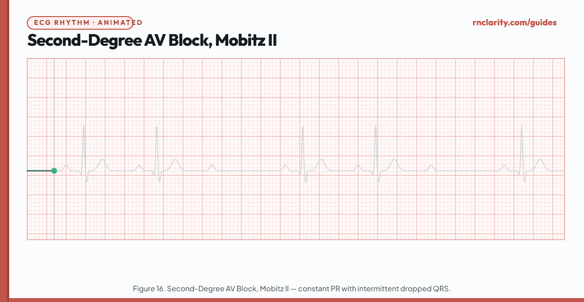 Animated ECG strip showing Second-Degree AV Block Type II (Mobitz II): regular P waves, PR interval remains constant from beat to beat, then a P wave suddenly fails to conduct without any warning lengthening of the PR interval, resulting in a dropped QRS.