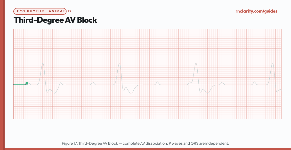 Animated ECG strip showing Third-Degree (Complete) AV Block: regular P waves at one rate, regular QRS complexes at a slower independent rate, no relationship between P waves and QRS complexes (AV dissociation), P waves appear before, within, and after QRS complexes with no consistent PR interval.