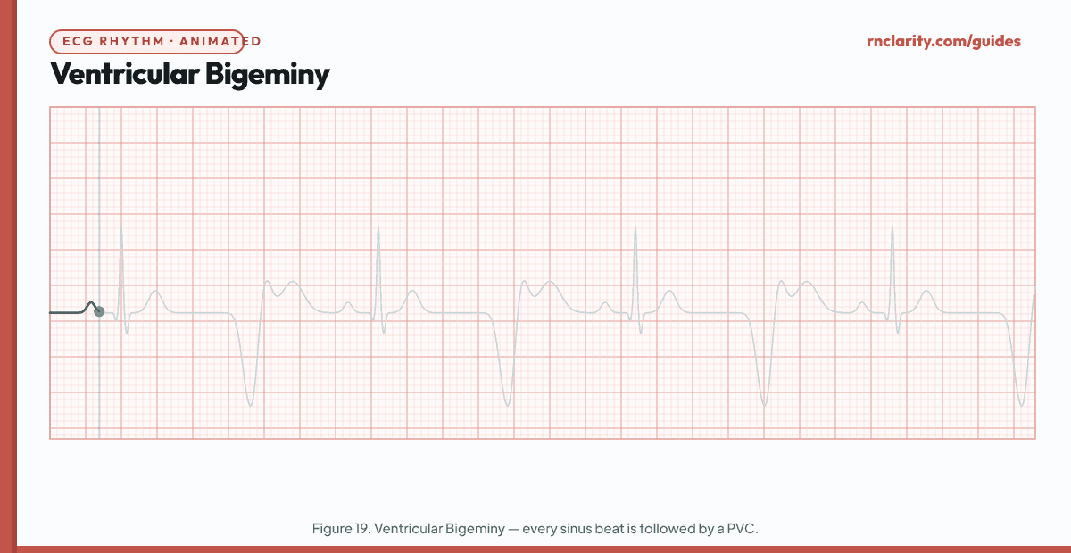 Animated ECG strip showing Ventricular Bigeminy: every other beat is a PVC, creating an alternating pattern of one sinus beat followed by one wide bizarre PVC, repeating in a regular coupled pattern throughout the strip.