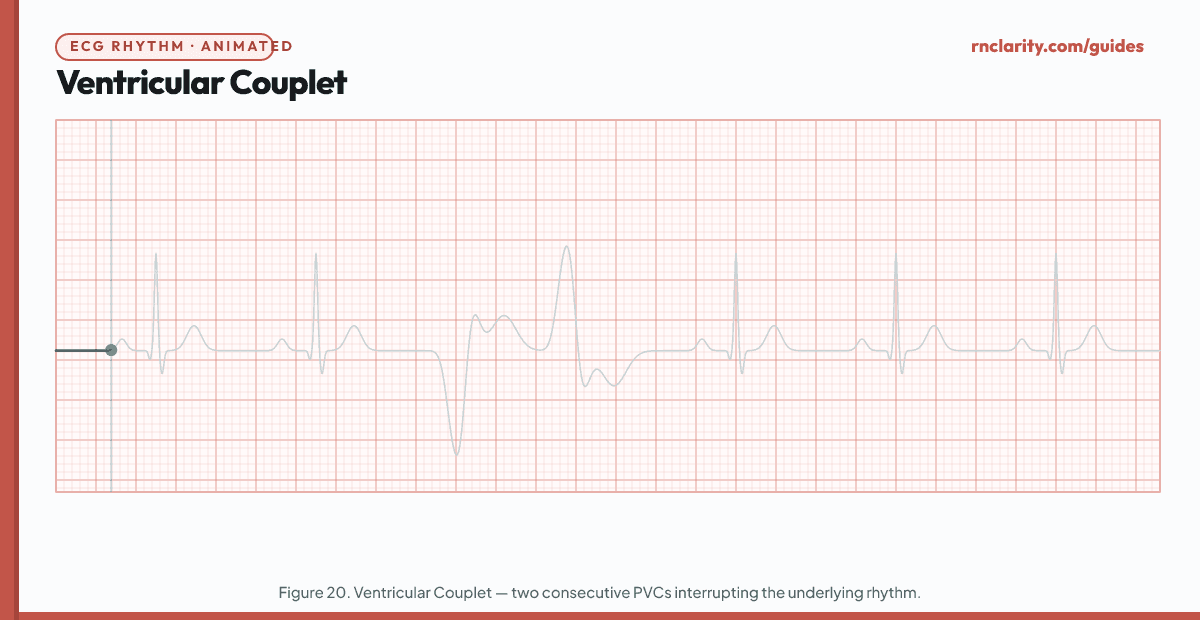 Animated ECG strip showing a Ventricular Couplet: underlying sinus rhythm interrupted by two consecutive PVCs in a row — two wide bizarre QRS complexes back to back without an intervening sinus beat, followed by return to sinus rhythm.