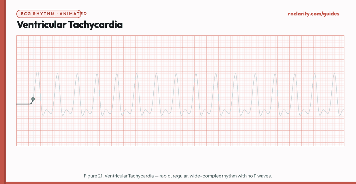 Animated ECG strip showing Monomorphic Ventricular Tachycardia: three or more consecutive wide bizarre QRS complexes at a rate of 100–250 per minute, all QRS complexes of identical morphology, no visible P waves, regular rhythm.