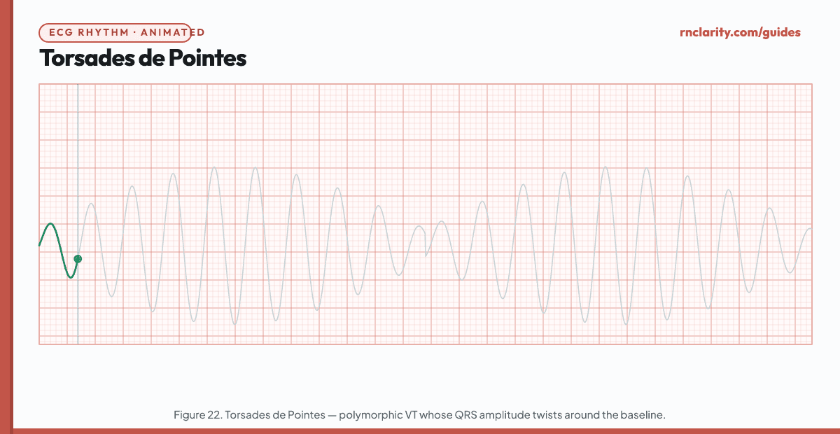 Animated ECG strip showing Torsades de Pointes: polymorphic ventricular tachycardia with a characteristic twisting pattern of QRS complexes that appear to rotate around the isoelectric baseline, alternating amplitude, rate 150–300 per minute, associated with prolonged QT interval on preceding sinus beats.